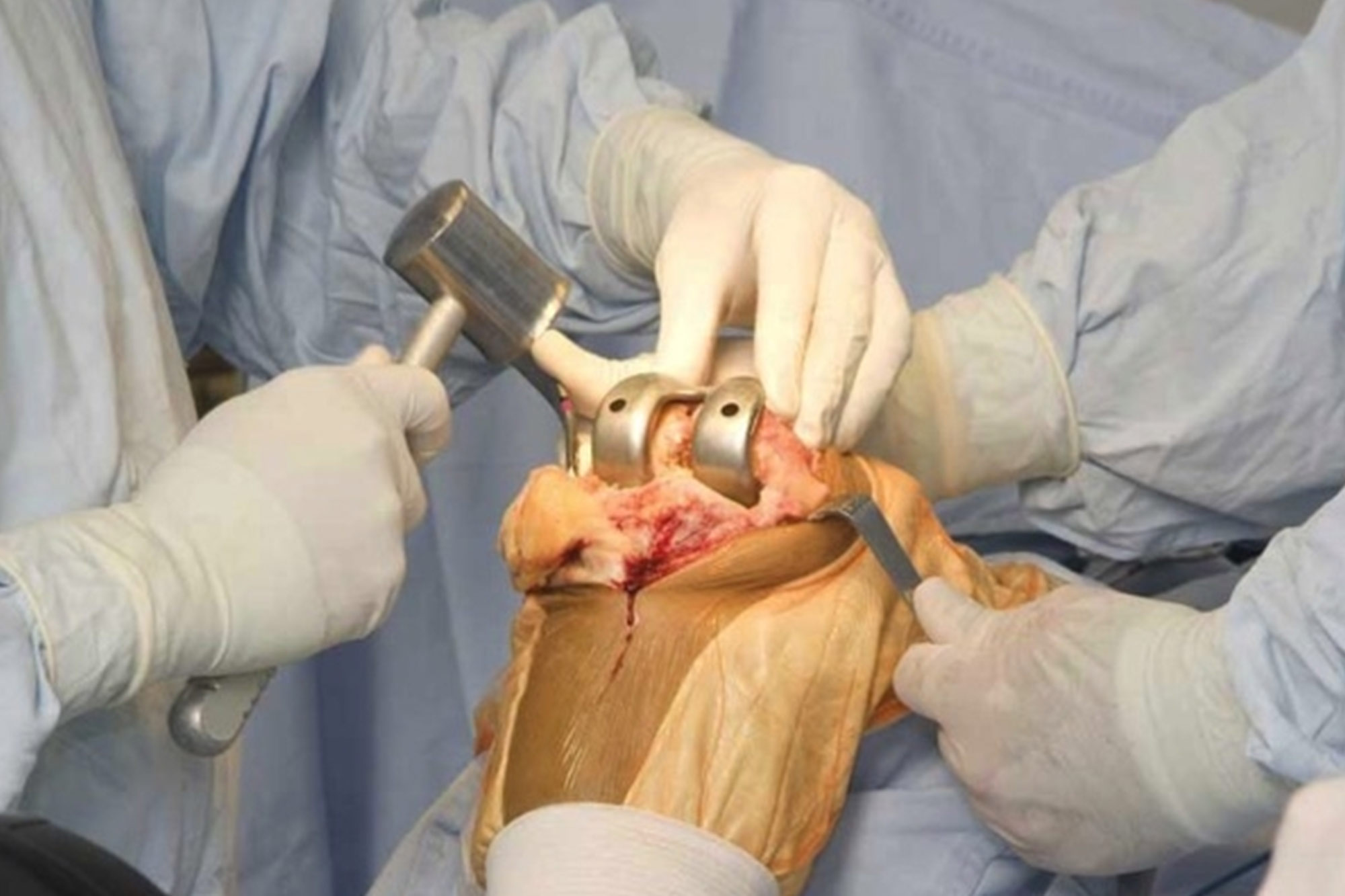 Knee Replacement Surgery Ahmedabad — Dr. Mitul Patel