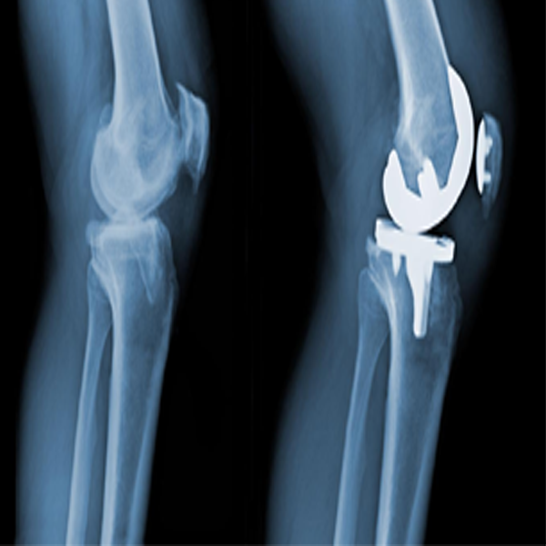 Advanced Revision Joint Replacement in Ahmedabad — Dr. Mitul Patel
