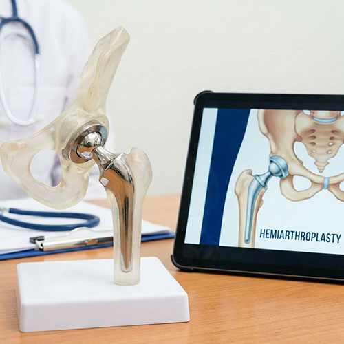 Partial Hip Replacement (Hemiarthroplasty)
