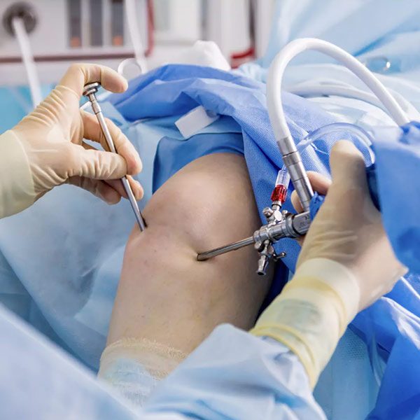 Arthroscopy